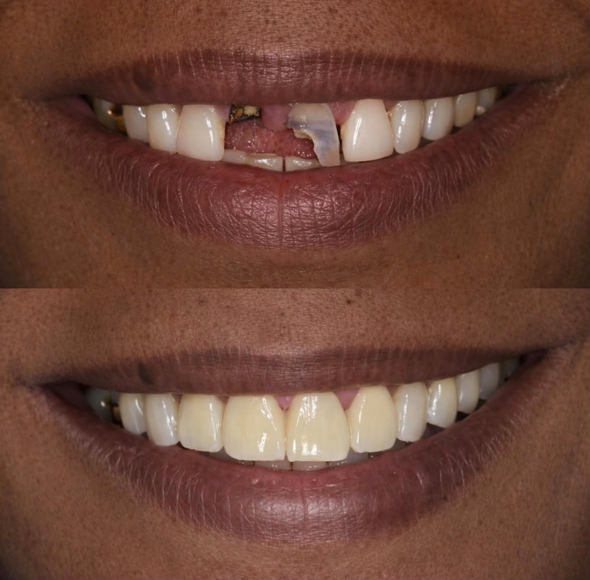 Before and after dental restoration, case one