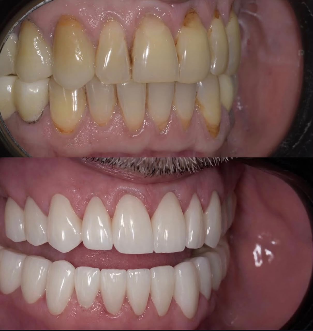 Before and after dental restoration, case ten
