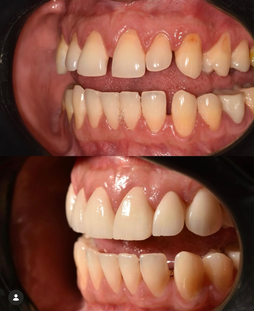 Before and after dental restoration, case eleven