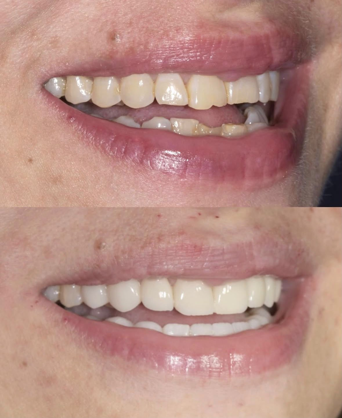 Before and after dental restoration, case two
