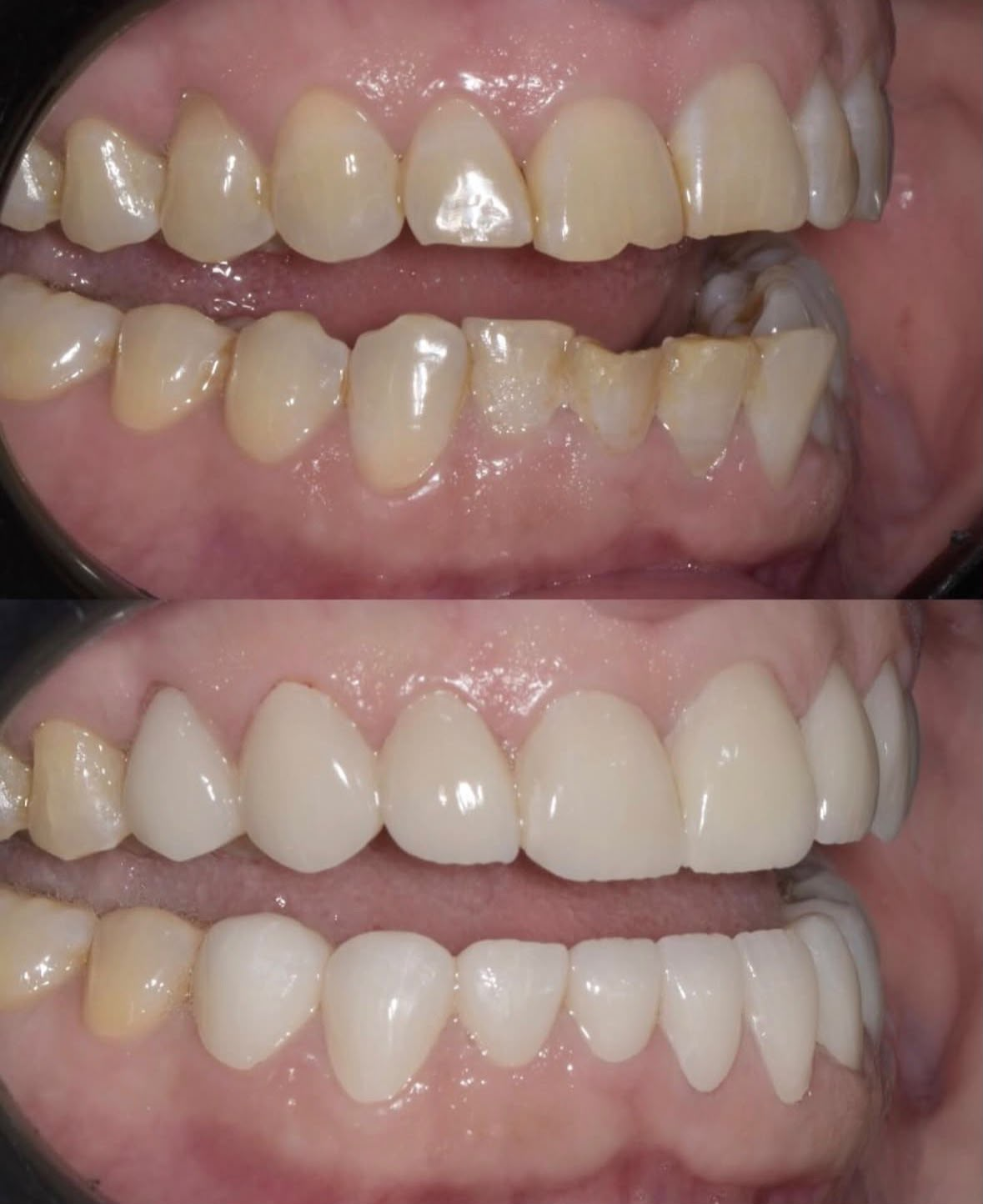 Before and after dental restoration, case three