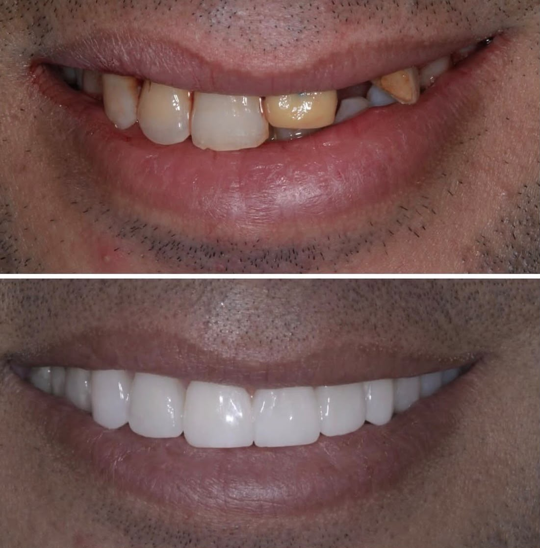 Before and after dental restoration, case four