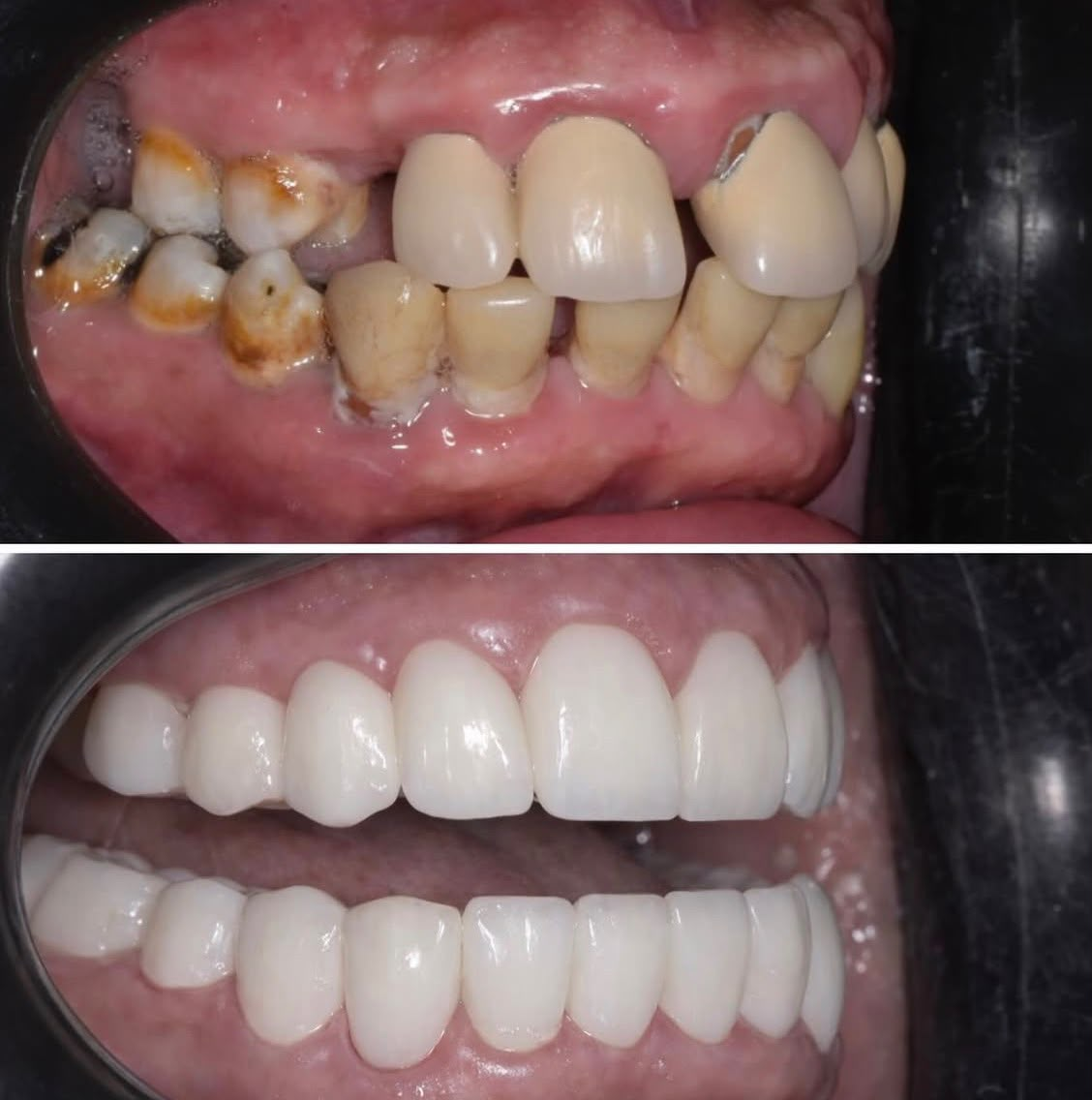 Before and after dental restoration, case five