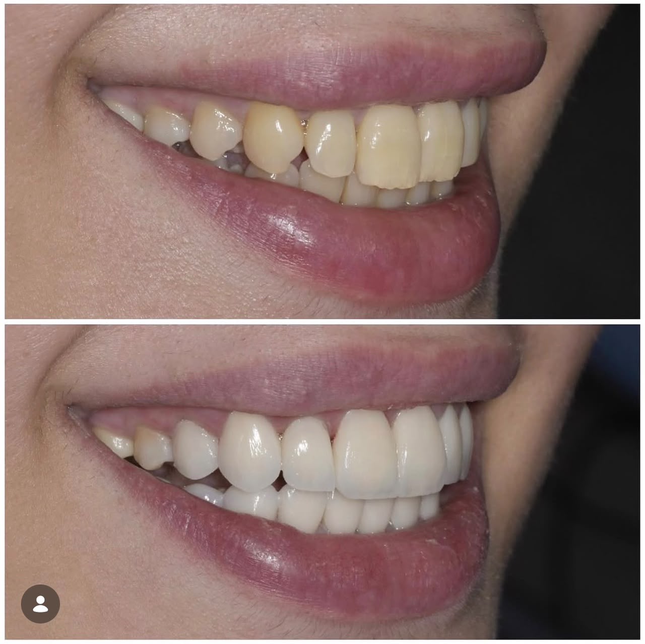 Before and after dental restoration, case six