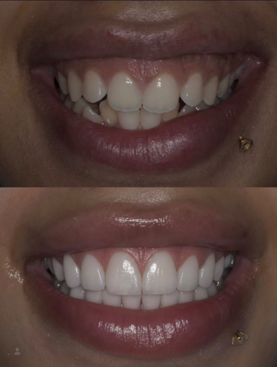 Before and after dental restoration, case seven