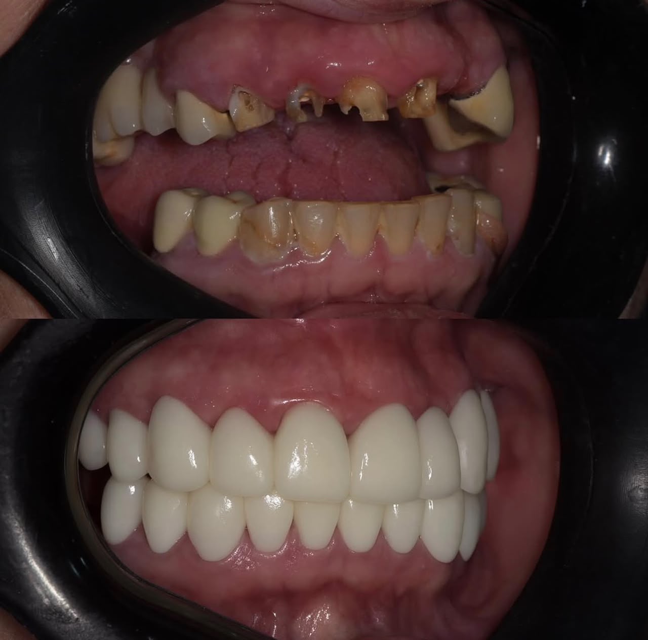 Before and after dental restoration, case eight