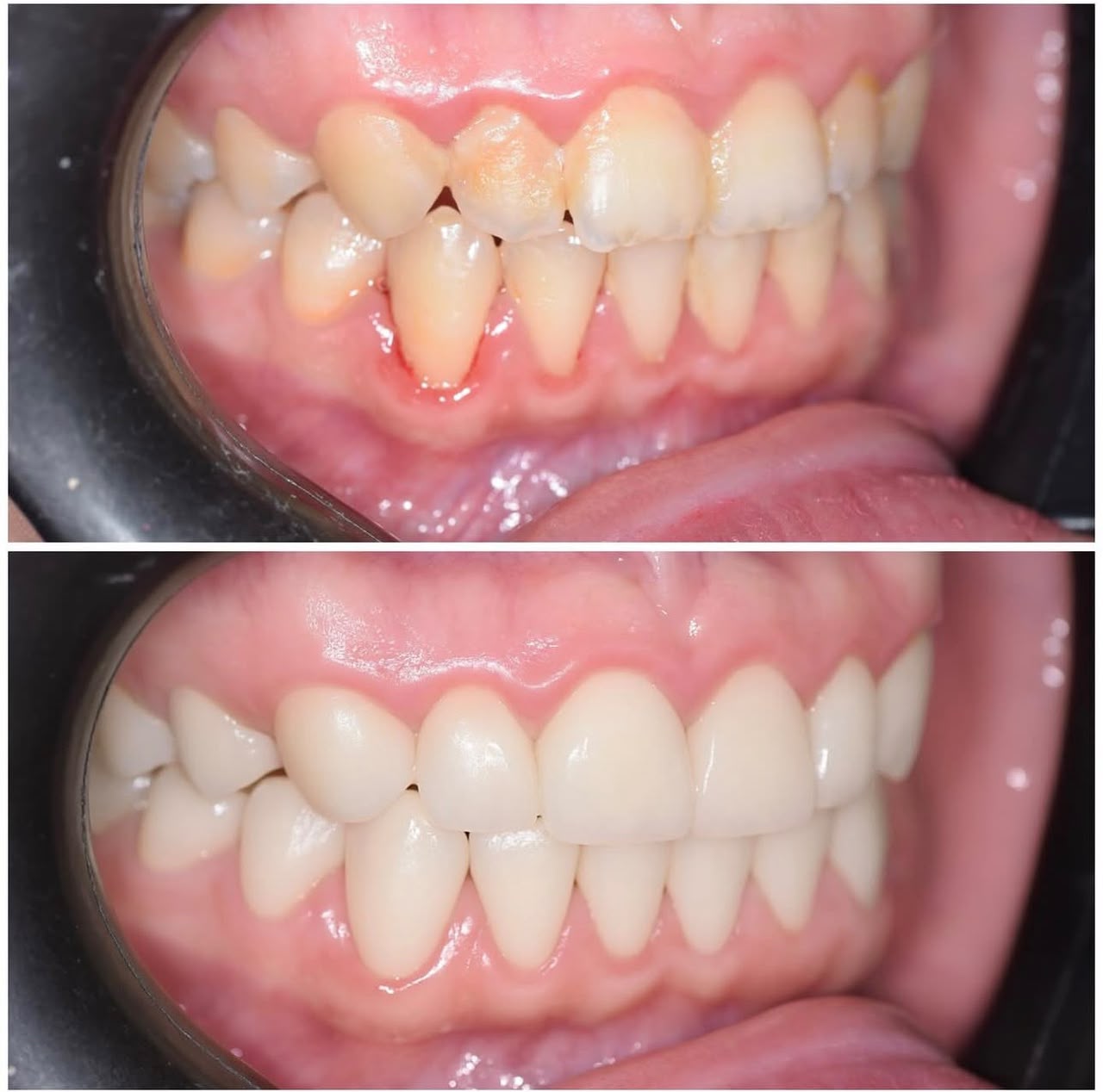 Before and after dental restoration, case nine